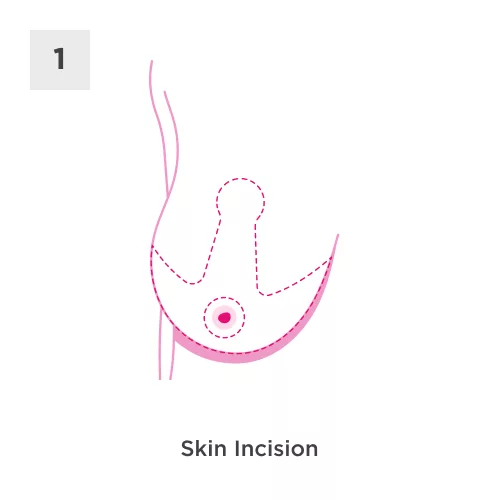 Breast Reduction Process 1
