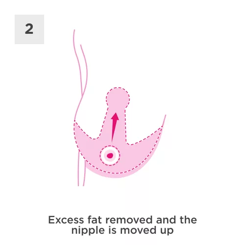Breast Reduction Process 2