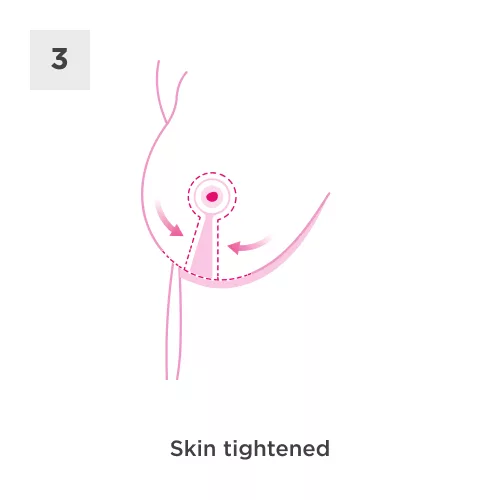 Breast Reduction Process 3