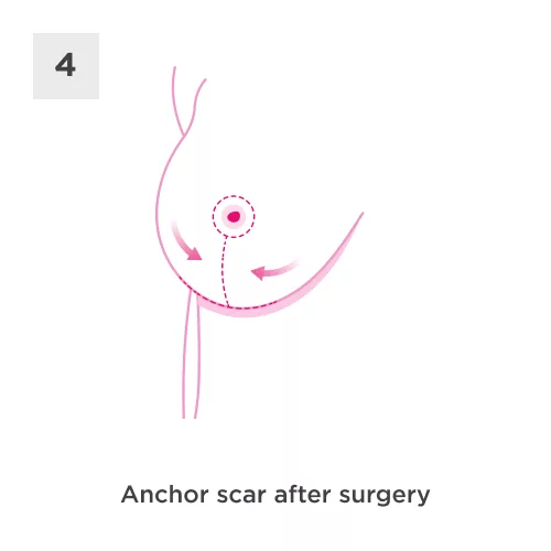 Breast Reduction Process 4
