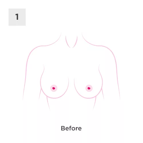 Breast Uplift Process 1