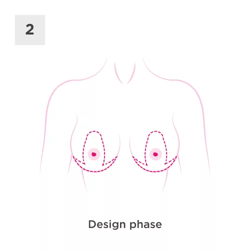 Breast Uplift Process 2