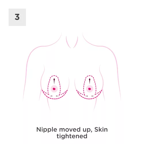 Breast Uplift Process 3