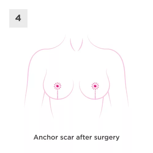 Breast Uplift Process 4